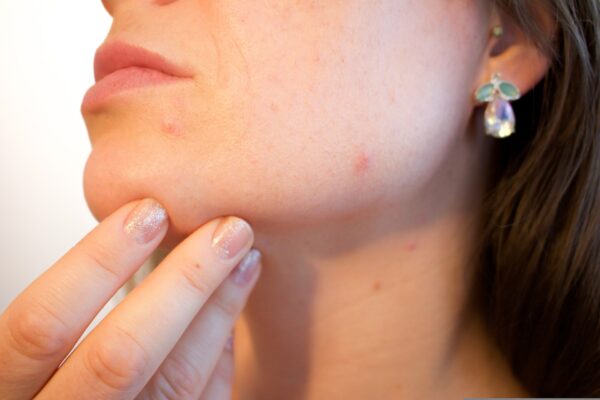 How To Get Rid Of Acne During Pregnancy And What You Should Know